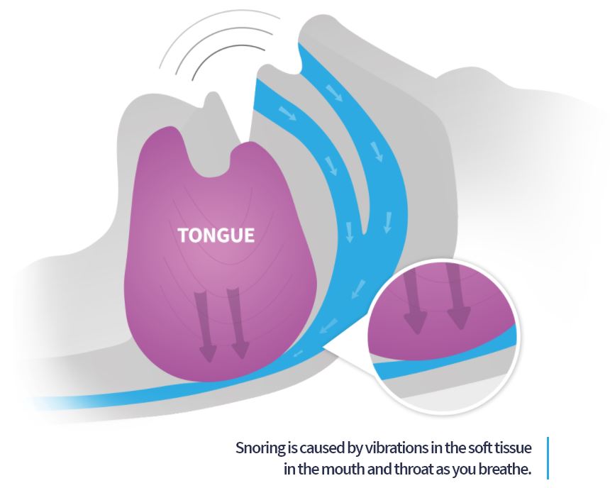 When we sleep our tongue and throat muscles are known to relax and cause snoring. In some people, these over relaxed muscles cause the tongue to fall back in the mouth, partially blocking the airway and resulting in snoring. Snoring deprives the body of quality sleep and can also create problems in relationships, such as sleeping in separate rooms.