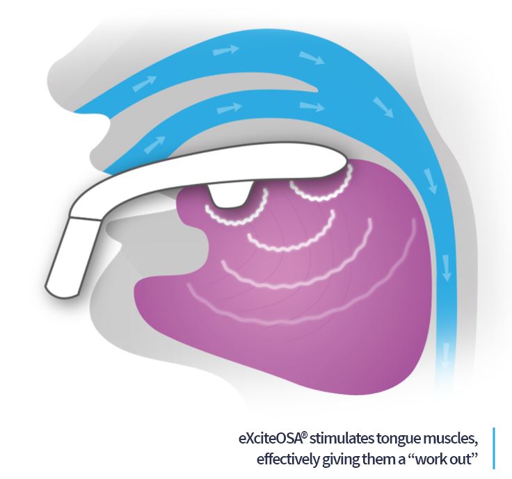 eXcite0SA - Daytime Therapy for Snoring and Obstructive Sleep Apnoea ...