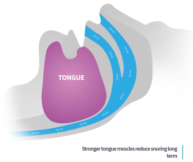 eXcite0SA - Daytime Therapy for Snoring and Obstructive Sleep Apnoea ...
