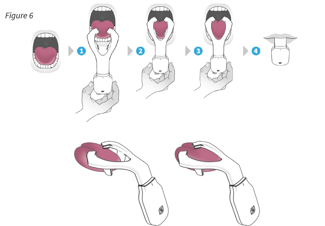 Placing eXciteOSA on tongue